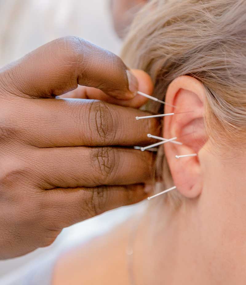 Facial Acupuncture