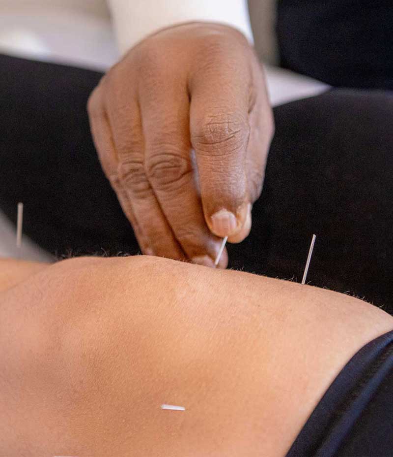 Acupuncture for knees